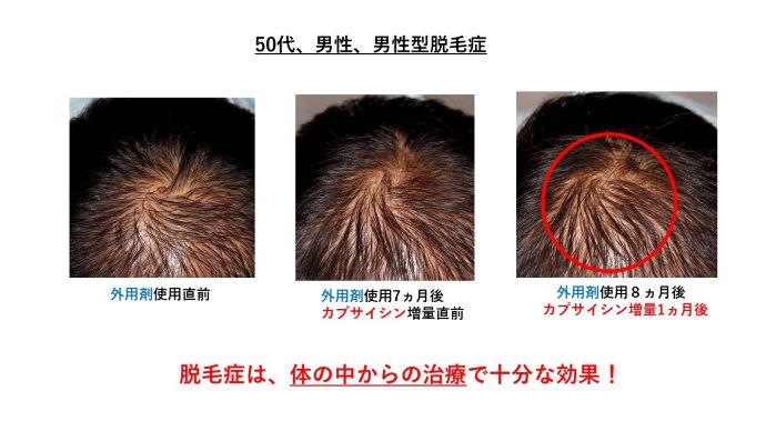 円形脱毛症　病院